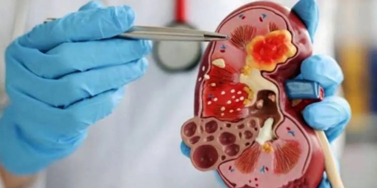 Ciri-ciri Ginjal Sehat dan Tanda-tanda Kerusakan Ginjal Menurut Dokter