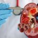 Ciri-ciri Ginjal Sehat dan Tanda-tanda Kerusakan Ginjal Menurut Dokter